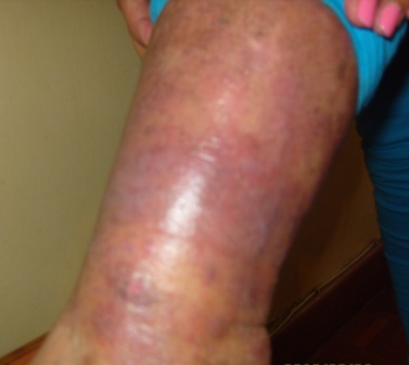 Before therapy